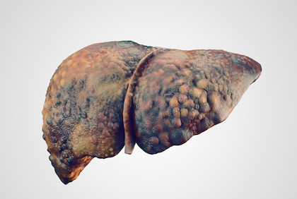 Liver cancer screening rates must improve