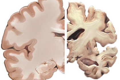 Study: Brain injury may boost risk of Alzheimer's earlier in life