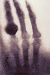 Blurry X-ray image of hand