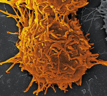 Microscopic image of single medullary thyroid cancer cell