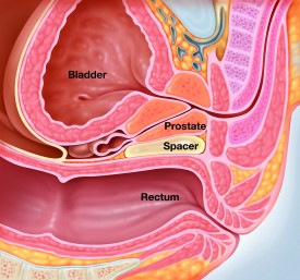 Graphic demonstrates how the spacer gel shifts the rectum away from the prostate gland.