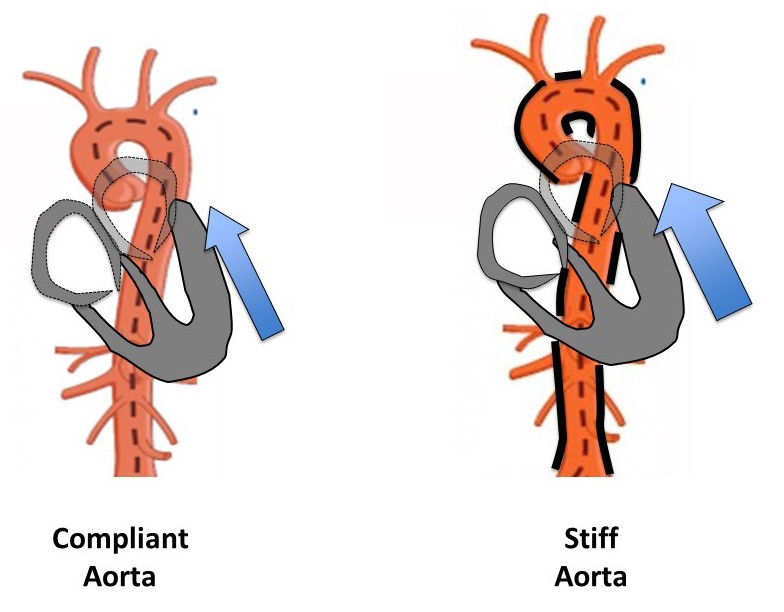 Diagram of stiff and compliant aortas