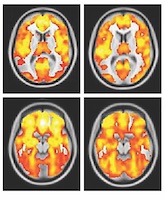 A UT Southwestern study found three distinct brain-based biomarkers of psychosis.