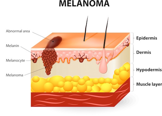 melanoma graphic