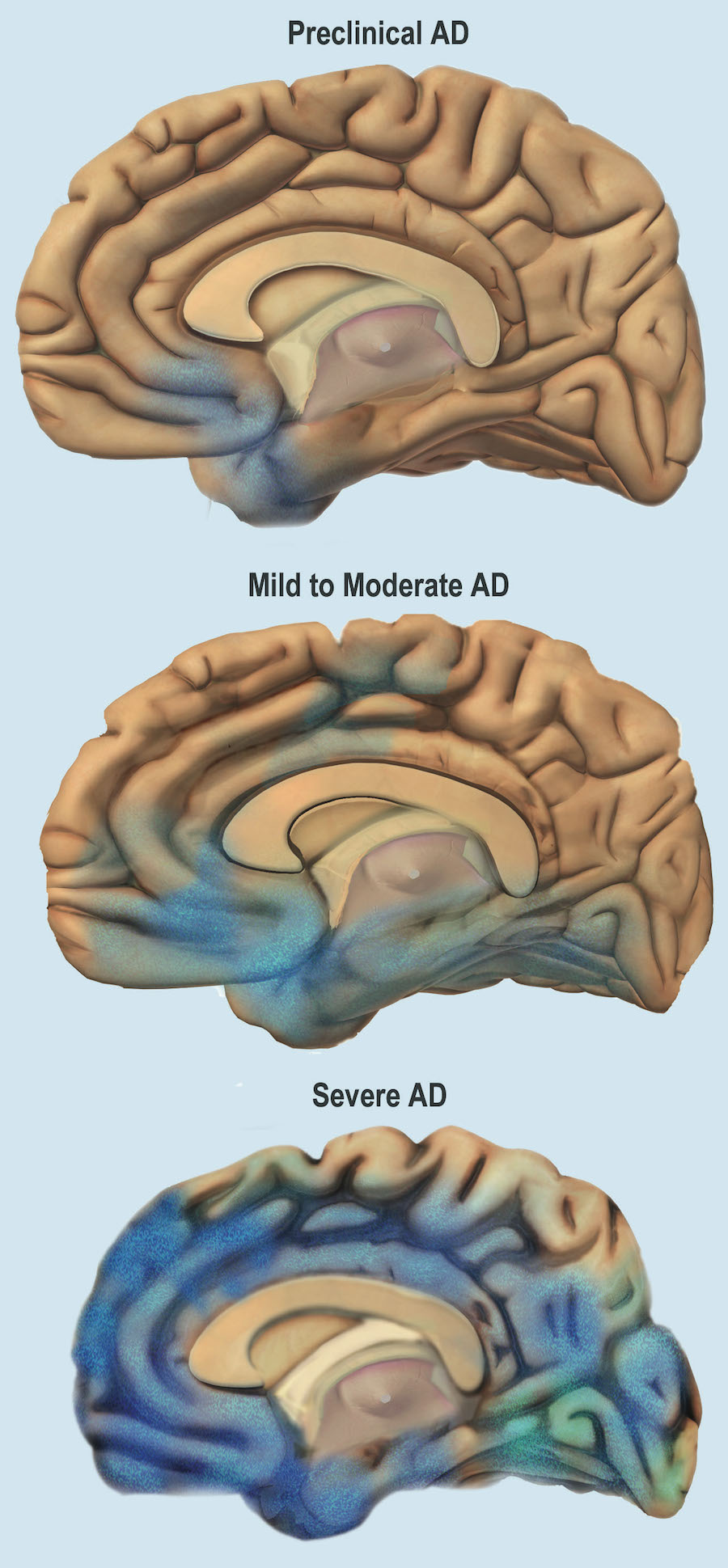 Various stages of brain deterioration due to Alzheimer's from pre-clinical, mild to moderate, and severe stages