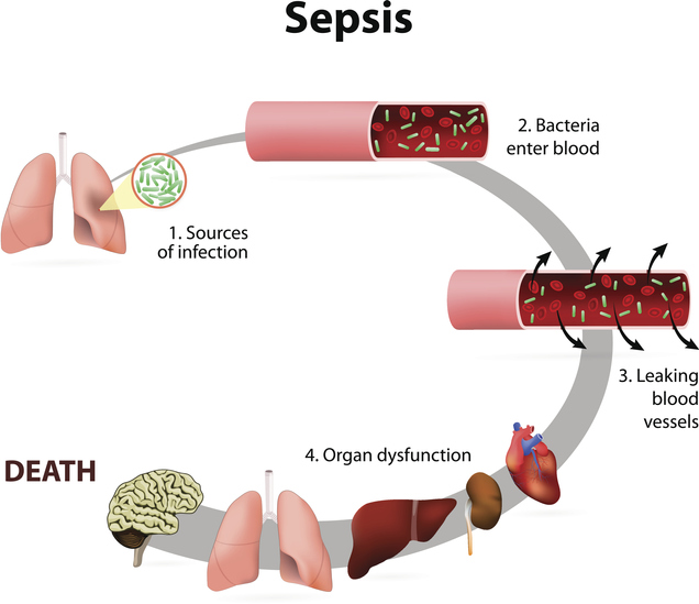 Sepsis infographic
