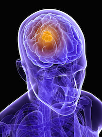 Diagram of brain with tumor location highlighted