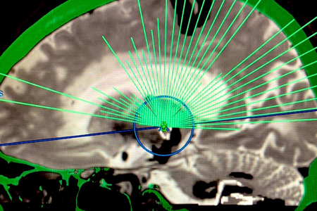 HIFU machine used for brain surgery