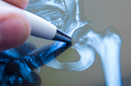 The end of an ink pen points to a bone fracture