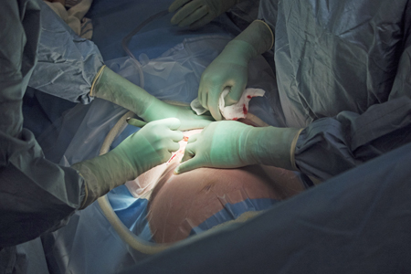 Doctors performing a c-section on a patient