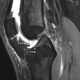 2D and 3D MRIs provide reliable measurements for planning ACL surgery
