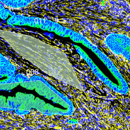 Stiffer colon could signal risk of early-onset colorectal cancer