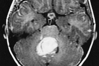 UTSW study helps explain launch switch for most common malignant pediatric brain tumor