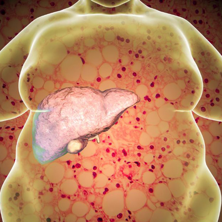 UT Southwestern immunologists uncover obesity-linked trigger to severe form of liver disease