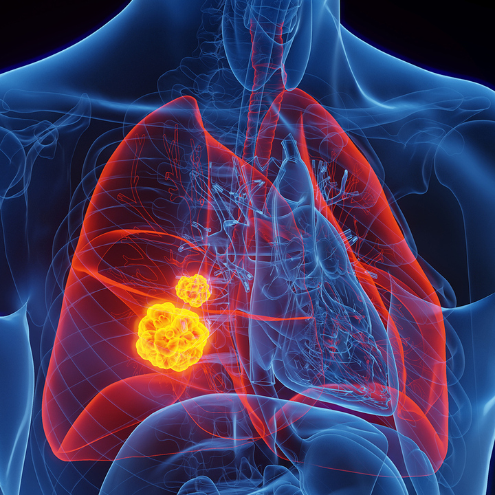 antibody-lung-cancer-thumb.jpg