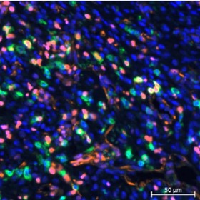 Experimental drug could spur immunotherapy response in patients with non-small cell lung cancer