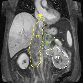 Unusual kidney cancer feature sheds light into how cancers invade and metastasize