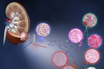 UT Southwestern cancer experts catalog, map kidney cancer tumors and progression