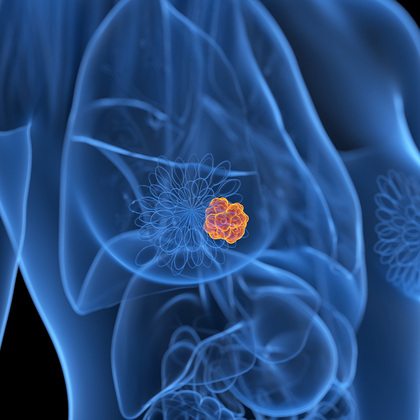 Three drugs target resistant breast cancers driven by <em>HER2</em> mutations