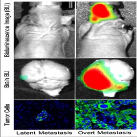 Metabolic vulnerabilities could be new targets for metastatic breast cancer