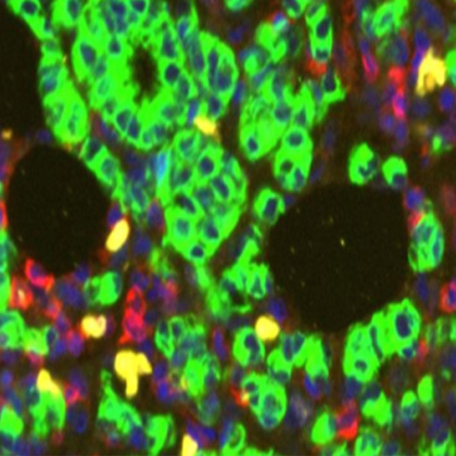 Study identifies why some breast cancers evade treatment