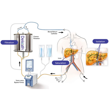 UTSW first in Texas to offer novel treatment for rare eye cancer that spreads to the liver