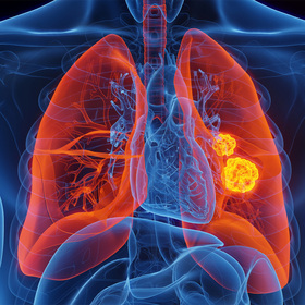 Lung cancer treatment shows promise in tumor models