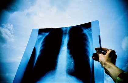 Drug combination fights resistance to lung cancer treatment