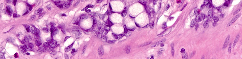 Anatomic Pathology tissue sample