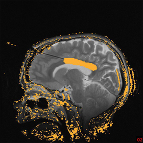 Laser procedure offers advantages for rare pediatric epilepsy surgery