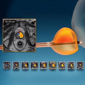UT Southwestern pioneers new minimally invasive treatment for prostate cancer