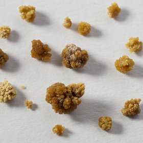 UTSW Research: Kidney stones, cancer diagnoses, and brain injury