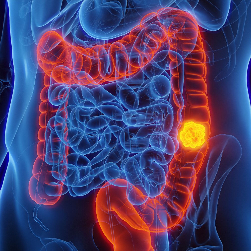 Personalized approach suggested on colorectal cancer screening