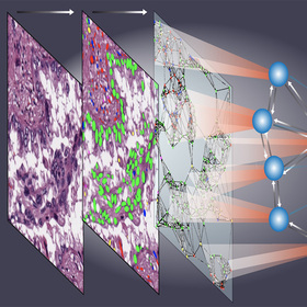 AI accurately predicts cancer outcomes from tissue samples