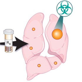 Clinical trial shows stereotactic radiation extends systemic therapy and slows kidney cancer progression