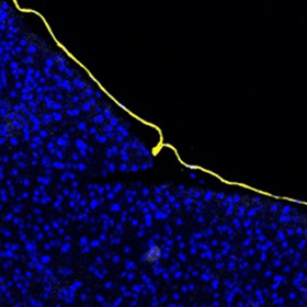 Breaking the shield that protects pancreatic cancer from immunotherapy