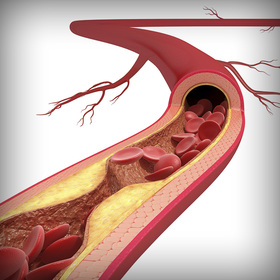 Patients who need high-intensity statins not using them