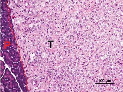 Where cancers go could guide their treatment