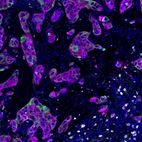 Type of KRAS mutation may guide more effective cancer treatments