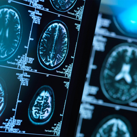 Distinguishing between two very similar pediatric brain conditions