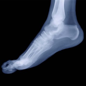 UT Southwestern reports foot problems increasing due to pandemic habits