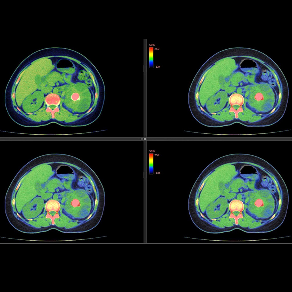 Kidney Stones: Emergency Department Diagnosis And Treatment