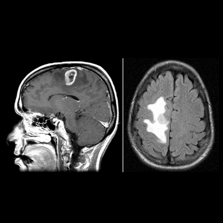 glioblastoma-treatment-thumb.jpg