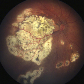 retinoblastoma-thumb.jpg