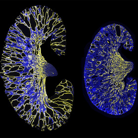 UT Southwestern researchers identify a gene therapy target for polycystic kidney disease