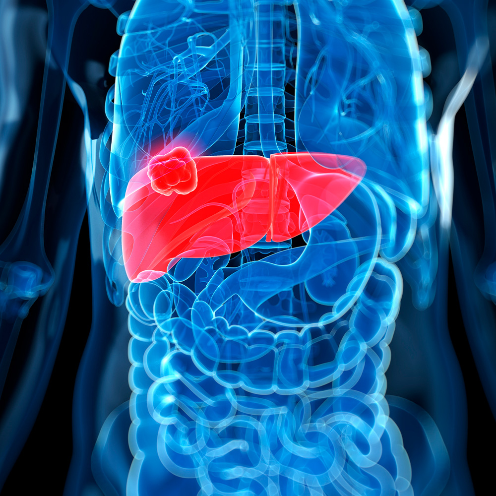 UTSW researchers develop blood test to predict liver cancer risk