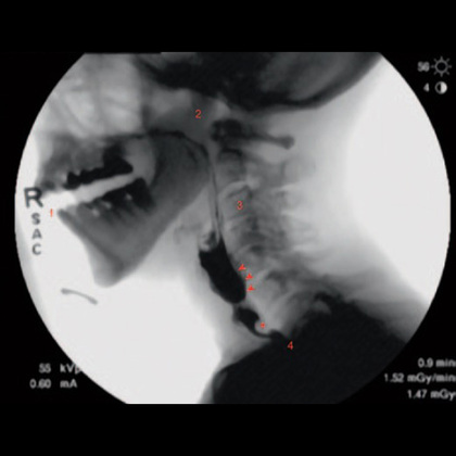 New guidelines laid out to standardize swallowing fluoroscopy