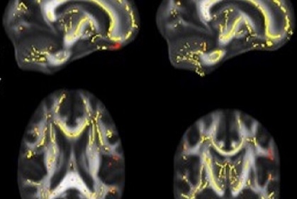 Poor fitness linked to weaker brain fiber, higher dementia risk
