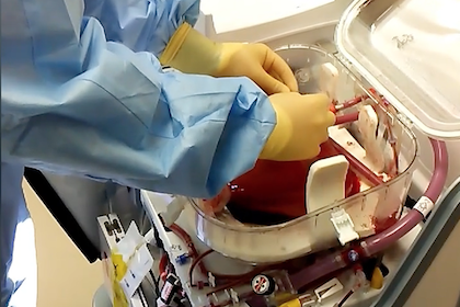 Warming up: New method of liver transplant keeps organ at body temperature