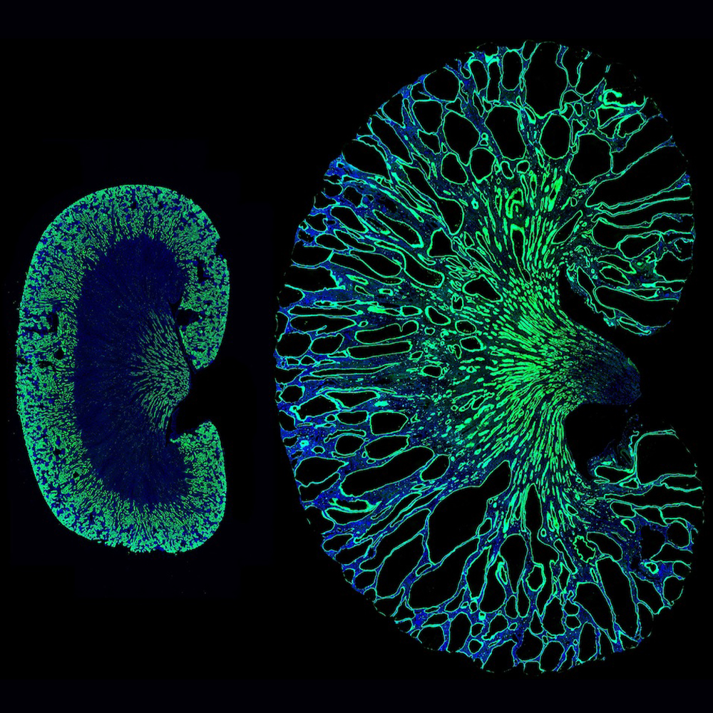 Chemical modification of RNA could play key role in polycystic kidney ...